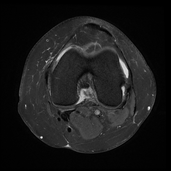 File:Anterior cruciate ligament tear, Wrisberg rip and bucket-handle tear of medial meniscus (Radiopaedia 75872-87266 Axial PD fat sat 14).jpg