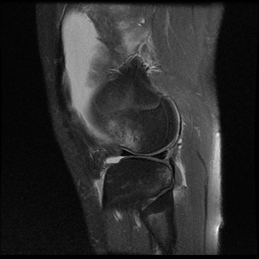 File:Anterior cruciate ligament tear (Radiopaedia 61500-69462 Sagittal PD fat sat 16).jpg