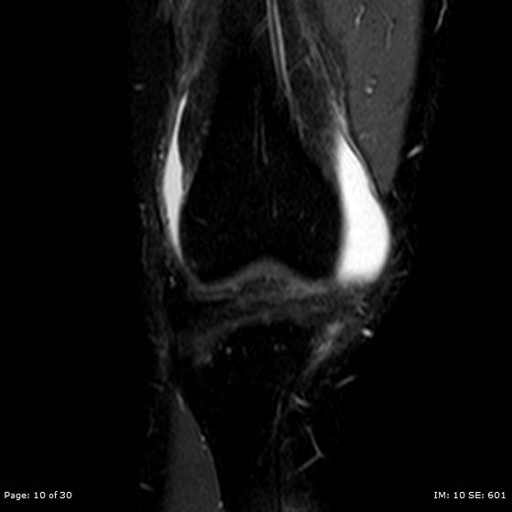 File:Anterior cruciate ligament tear (Radiopaedia 70783-80964 Coronal STIR 10).jpg