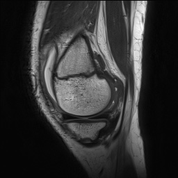 File:Anterior cruciate ligament tear - pediatric (Radiopaedia 62152-70260 Sagittal PD 43).jpg