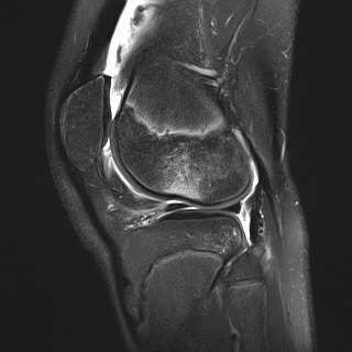 File:Anterior cruciate ligament tear - pediatric (Radiopaedia 62152-70260 Sagittal PD fat sat 26).jpg