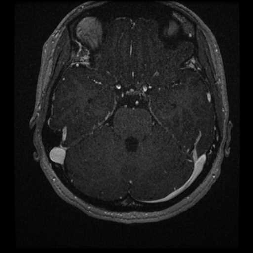 Anterior inferior cerebellar artery vascular loop - type II (Radiopaedia 70991-81209 Axial T1 C+ 13).jpg