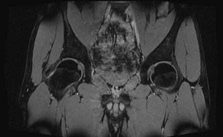 Anterior inferior iliac spine avulsion fracture (Radiopaedia 81312-95000 G 49).jpg