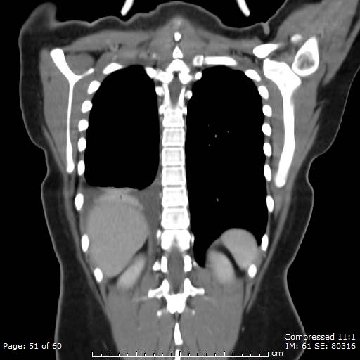 File:Anterior mediastinal B cell Lymphoma (Radiopaedia 50677-56114 B 26).jpg