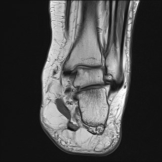 File:Anterior talofibular ligament injury - rupture with soft-tissue impingement (Radiopaedia 38765-40928 Coronal PD 13).jpg