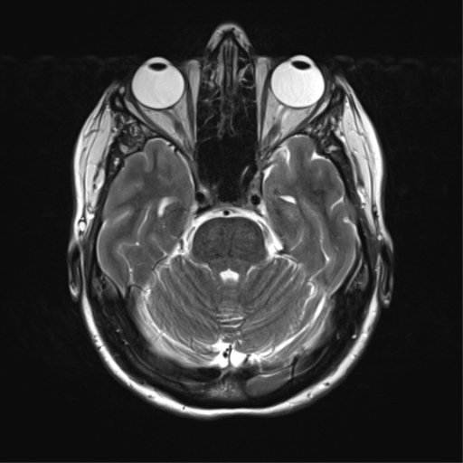 File:Anterior temporal lobe perivascular space (Radiopaedia 40946-43650 Axial T2 12).png