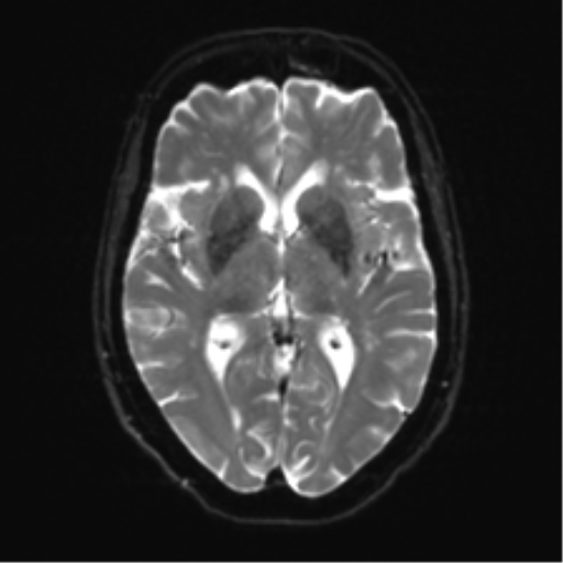 Anterior temporal pole cysts (Radiopaedia 46629-51102 Axial DWI 14).png