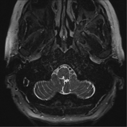 Anterior temporal pole cysts (Radiopaedia 46629-51102 Axial T2 3).png