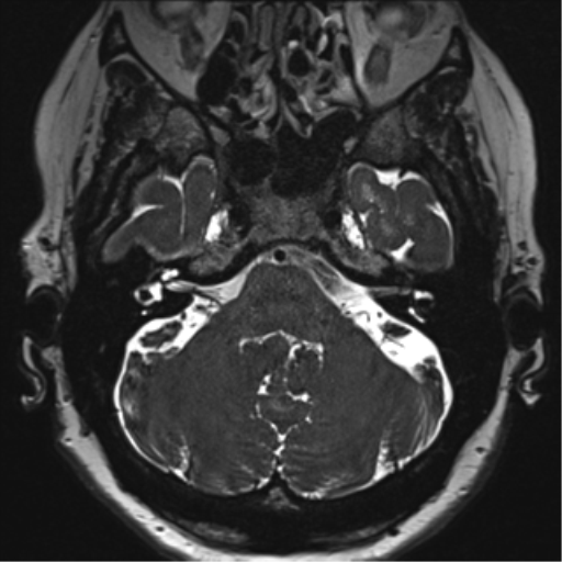 Anterior temporal pole cysts (Radiopaedia 46629-51102 Axial T2 31).png