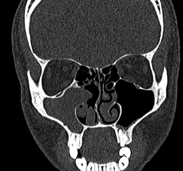 Antrochoanal polyp (Radiopaedia 30002-30554 Coronal bone window 36).jpg