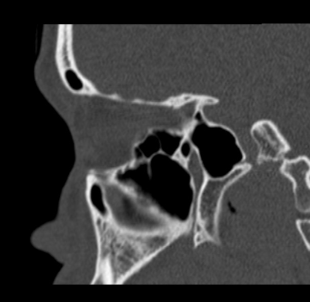 Antrochoanal polyp (Radiopaedia 33984-35202 Sagittal bone window 54).jpg