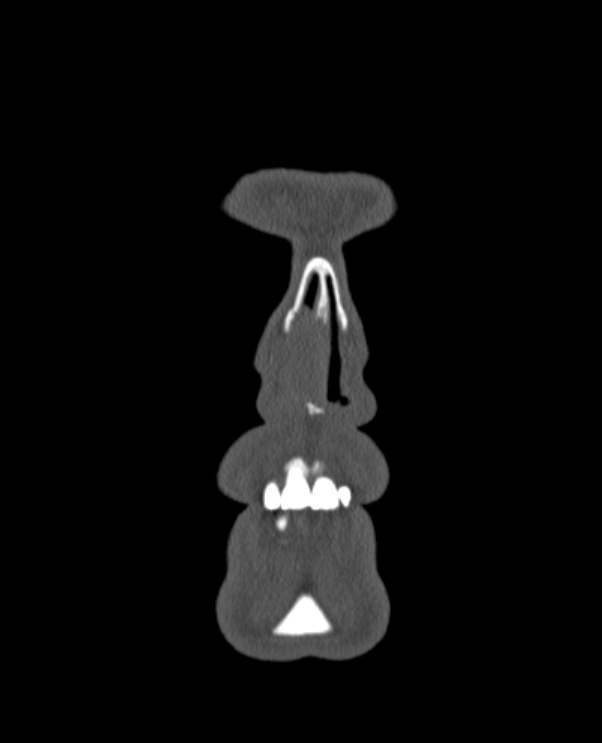 Antrochoanal polyp (Radiopaedia 79011-92169 Coronal bone window 90).jpg