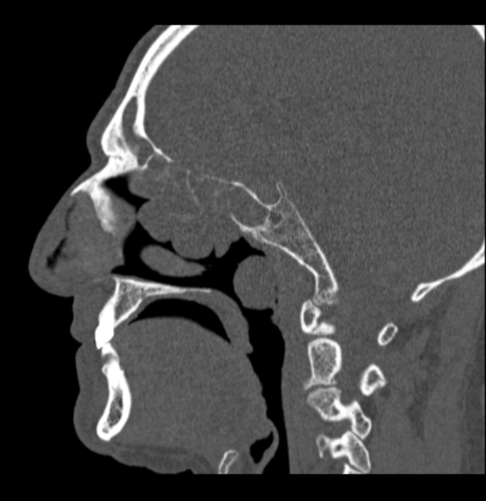 Antrochoanal polyp (Radiopaedia 79011-92169 Sagittal bone window 37).jpg