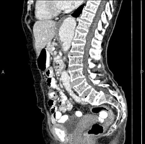 Aortic aneurysm and Lemmel syndrome (Radiopaedia 86499-102554 D 46).jpg