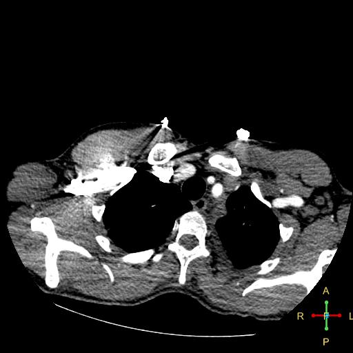 File:Aortic aneurysm and penetrating ulcer (Radiopaedia 23590-23704 A 4).jpg