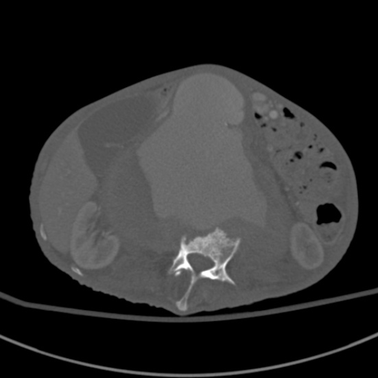 Aortic aneurysm with spinal destruction (Radiopaedia 42301-45410 Axial bone window 42).jpg