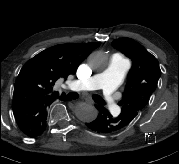 File:Aortic dissection (CTPA) (Radiopaedia 75506-86751 Axial C+ CTPA 65).jpg