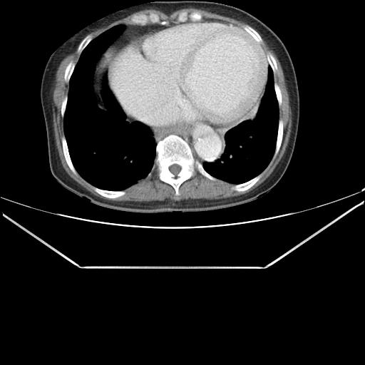 File:Aortic dissection (Radiopaedia 25350-25604 C 38).jpg