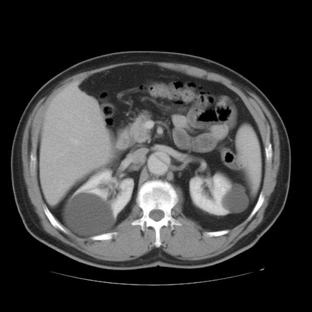 Aortic dissection (Radiopaedia 44411-48061 C 77).jpg