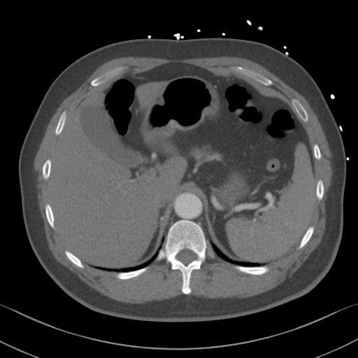 File:Aortic dissection (Radiopaedia 50763-56234 A 75).png