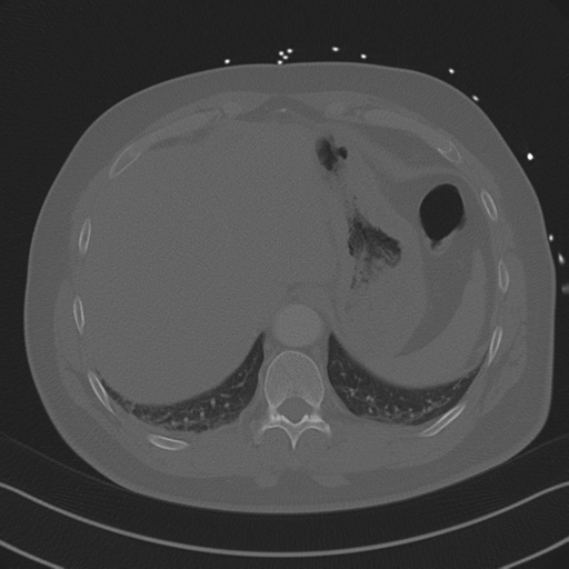Aortic dissection (Radiopaedia 50763-56234 Axial bone window 87).png