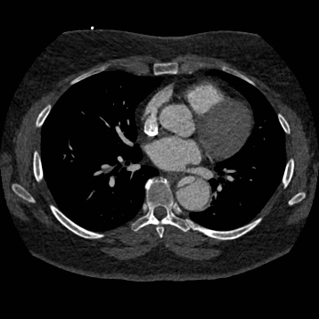 Aortic dissection (Radiopaedia 57969-64959 A 173).jpg