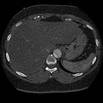 File:Aortic dissection (Radiopaedia 57969-64959 A 283).jpg