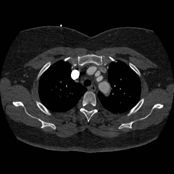 Aortic dissection (Radiopaedia 57969-64959 A 76).jpg