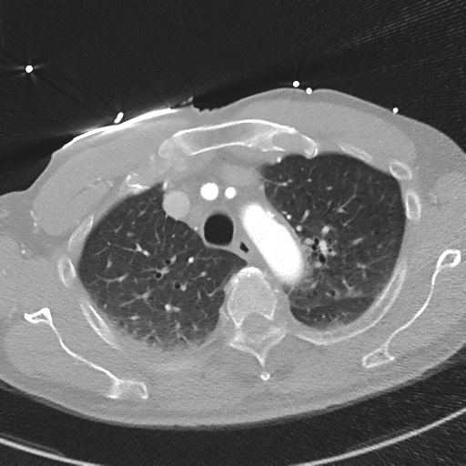 Aortic dissection - DeBakey type II (Radiopaedia 64302-73082 Axial lung window 15).png