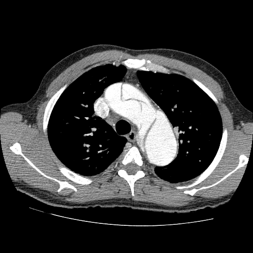 Aortic dissection - Stanford A -DeBakey I (Radiopaedia 28339-28587 B 17).jpg