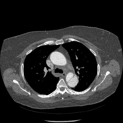 Aortic dissection - Stanford type B (Radiopaedia 88281-104910 A 25).jpg