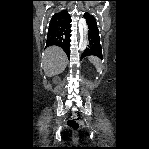 File:Aortic dissection - Stanford type B (Radiopaedia 88281-104910 B 65).jpg