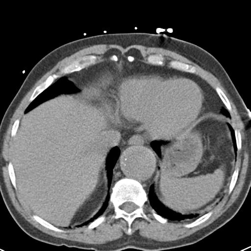 Aortic intramural hematoma (Radiopaedia 31139-31838 Axial non-contrast 44).jpg
