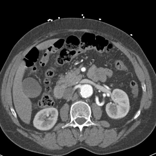 Aortic intramural hematoma (Radiopaedia 31139-31838 B 100).jpg