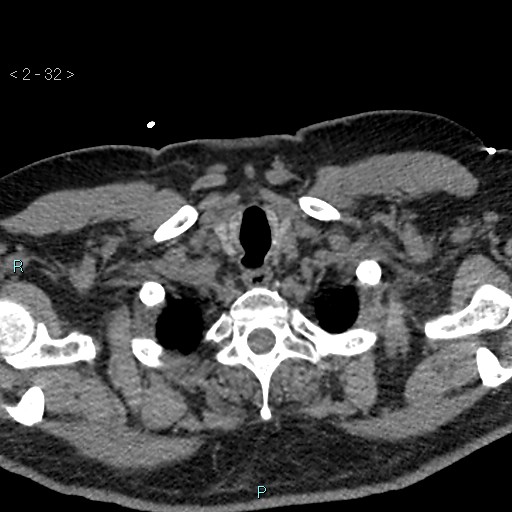 Aortic intramural hematoma (Radiopaedia 48463-53380 Axial non-contrast 14).jpg