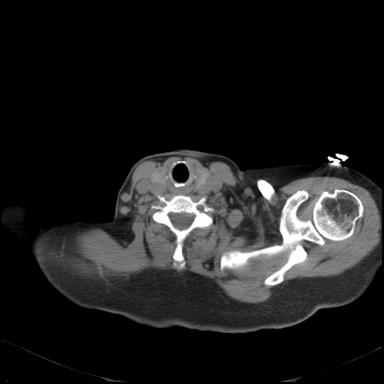 Aortic intramural hematoma with dissection and intramural blood pool (Radiopaedia 77373-89491 Axial non-contrast 4).jpg