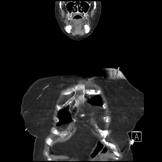 File:Aortic intramural hematoma with dissection and intramural blood pool (Radiopaedia 77373-89491 C 2).jpg
