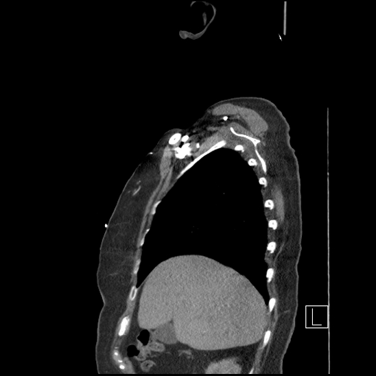 Aortic intramural hematoma with dissection and intramural blood pool (Radiopaedia 77373-89491 D 15).jpg