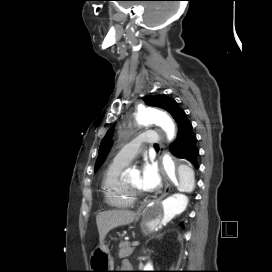 File:Aortic intramural hematoma with dissection and intramural blood pool (Radiopaedia 77373-89491 D 53).jpg