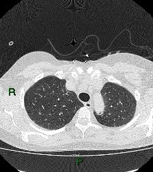File:Aortic valve endocarditis (Radiopaedia 87209-103485 Axial lung window 25).jpg