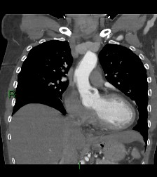 Aortic valve endocarditis (Radiopaedia 87209-103485 D 42).jpg