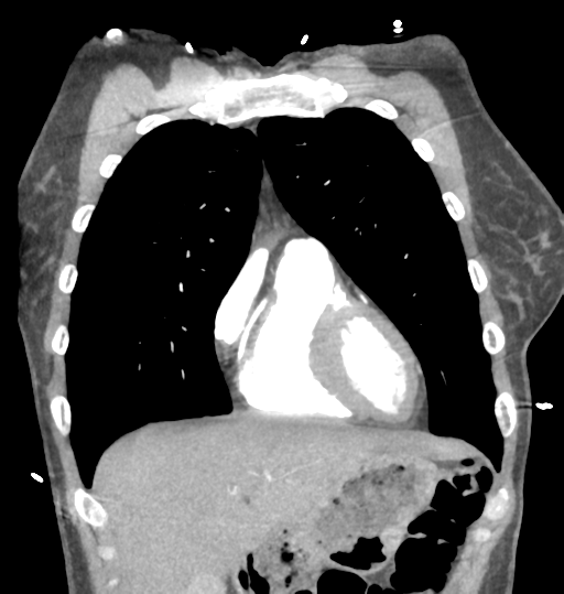 Aortic valve non-coronary cusp thrombus (Radiopaedia 55661-62189 C 22).png