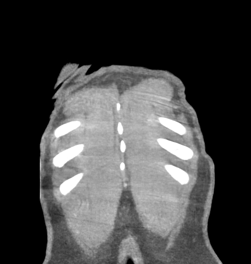 File:Aortic valve non-coronary cusp thrombus (Radiopaedia 55661-62189 C 77).png