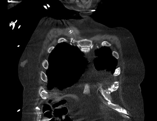 Aortoesophageal fistula with endovascular repair (Radiopaedia 73781-84592 Coronal C+ CTPA 8).jpg