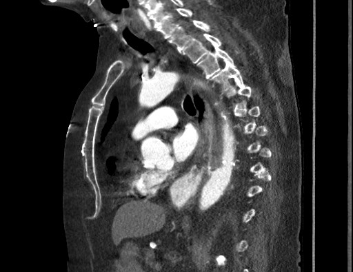 Aortoesophageal fistula with endovascular repair (Radiopaedia 73781-84592 Sagittal C+ CTPA 108).jpg