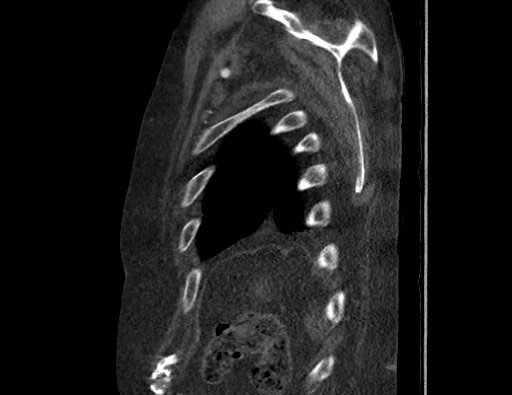 File:Aortoesophageal fistula with endovascular repair (Radiopaedia 73781-84592 Sagittal C+ CTPA 179).jpg