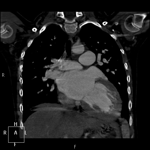 File:Aortopulmonary septal defect (Radiopaedia 41990-45013 Coronal C+ CTPA 30).jpg