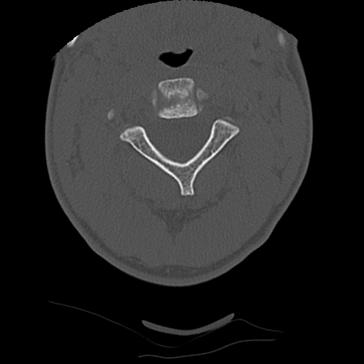Apical pneumothorax on cervical spine CT (Radiopaedia 45343-49368 Axial bone window 27).jpg