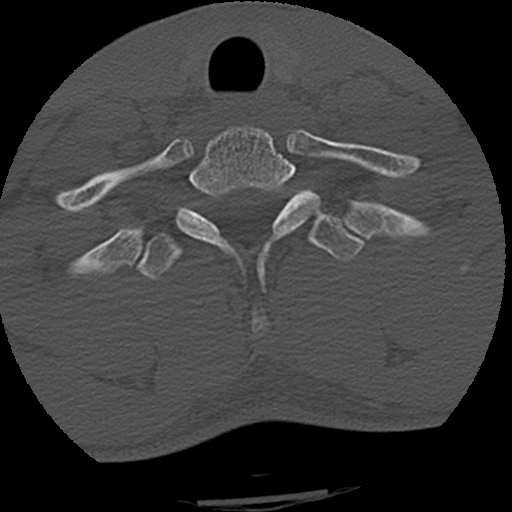 File:Apical pneumothorax on cervical spine CT (Radiopaedia 45343-49368 Axial bone window 80).jpg
