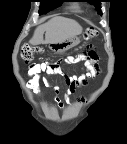 File:Appendiceal abscesses (Radiopaedia 50999-56542 Coronal non-contrast 16).png